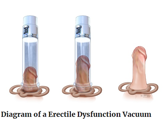 Diagram of a Erectile Dysfunction Vacuum
